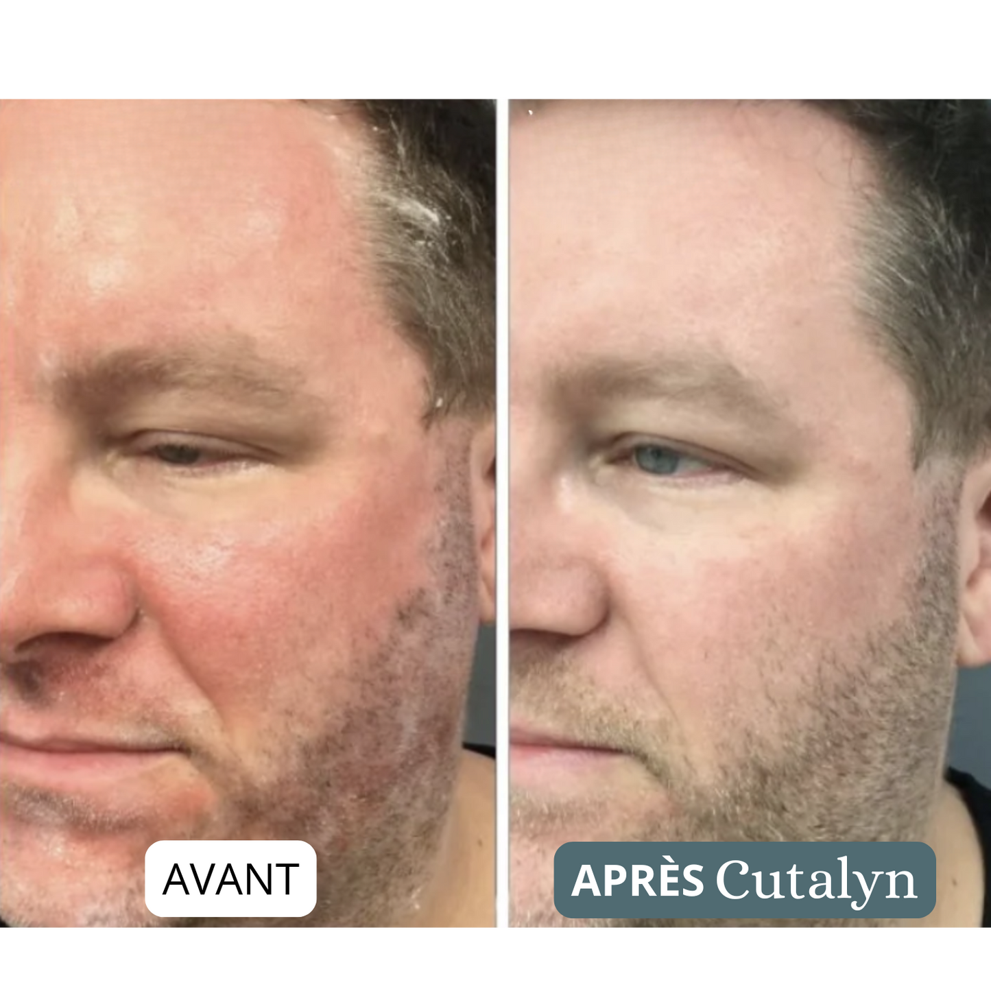 SensiCalm® Duo+ ⎜ Barbe & cuir chevelu apaisés